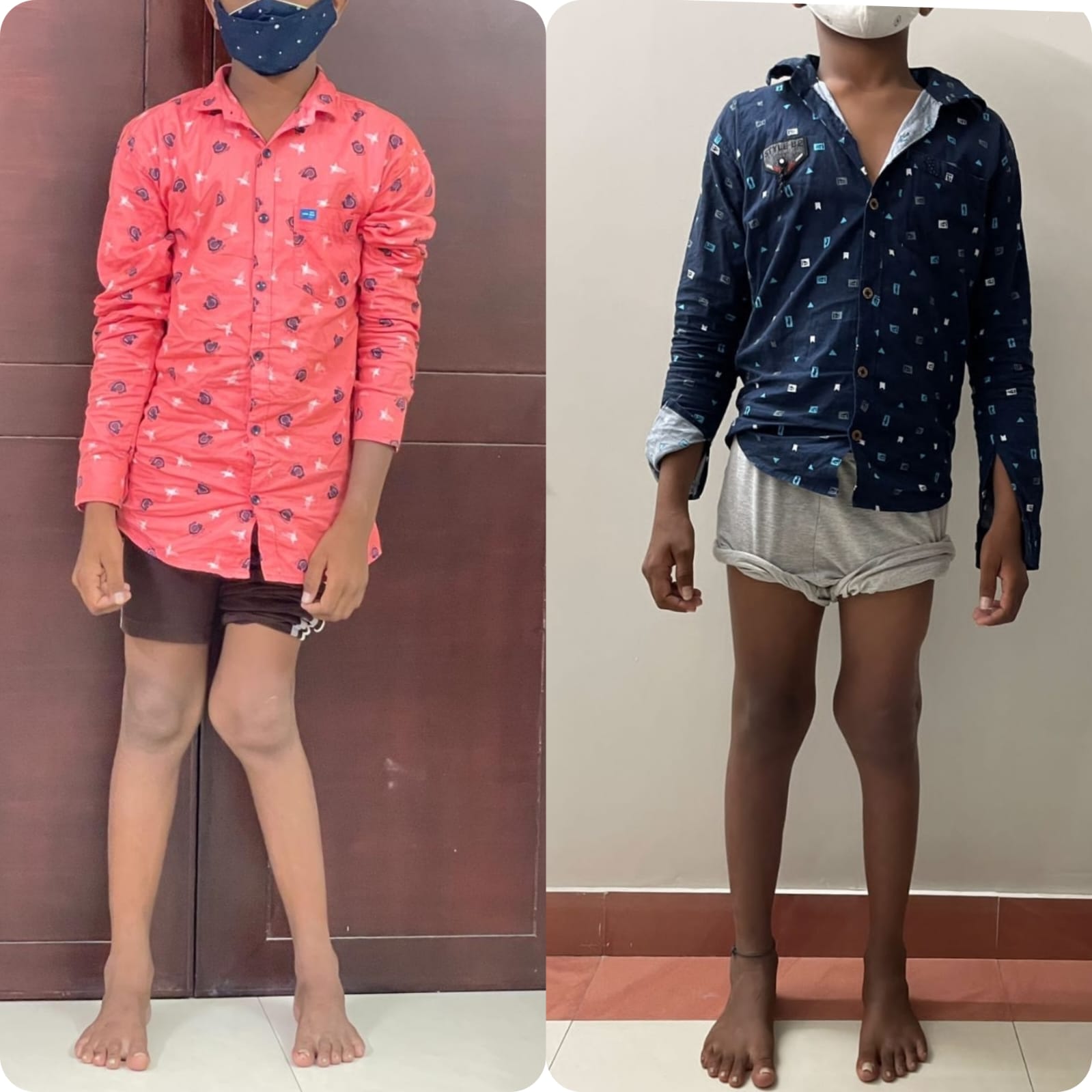 Knock Knees Treatment